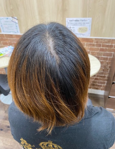 施術例　ビフォー1