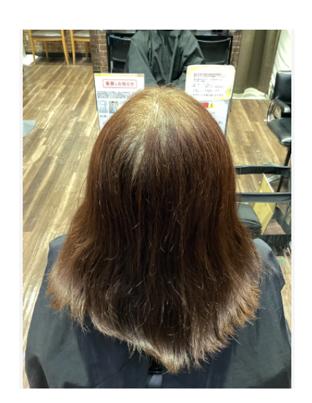 施術例　ビフォー2