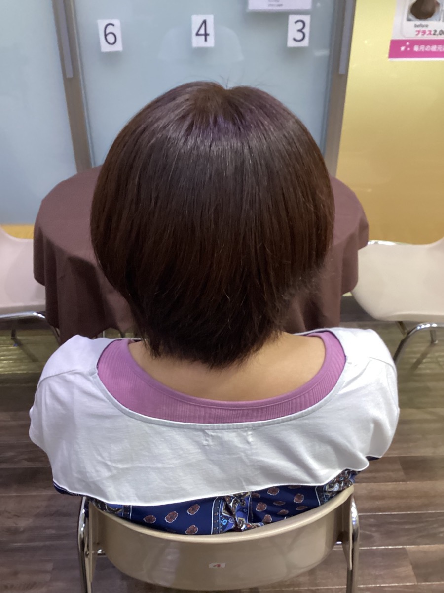 施術例　アフター1