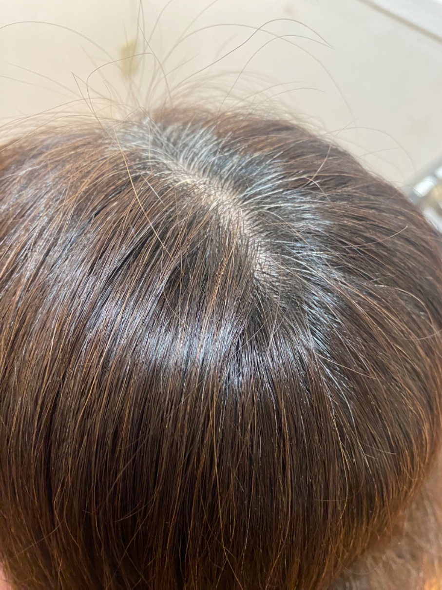 施術例　ビフォー1